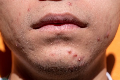 cicatrices_acne